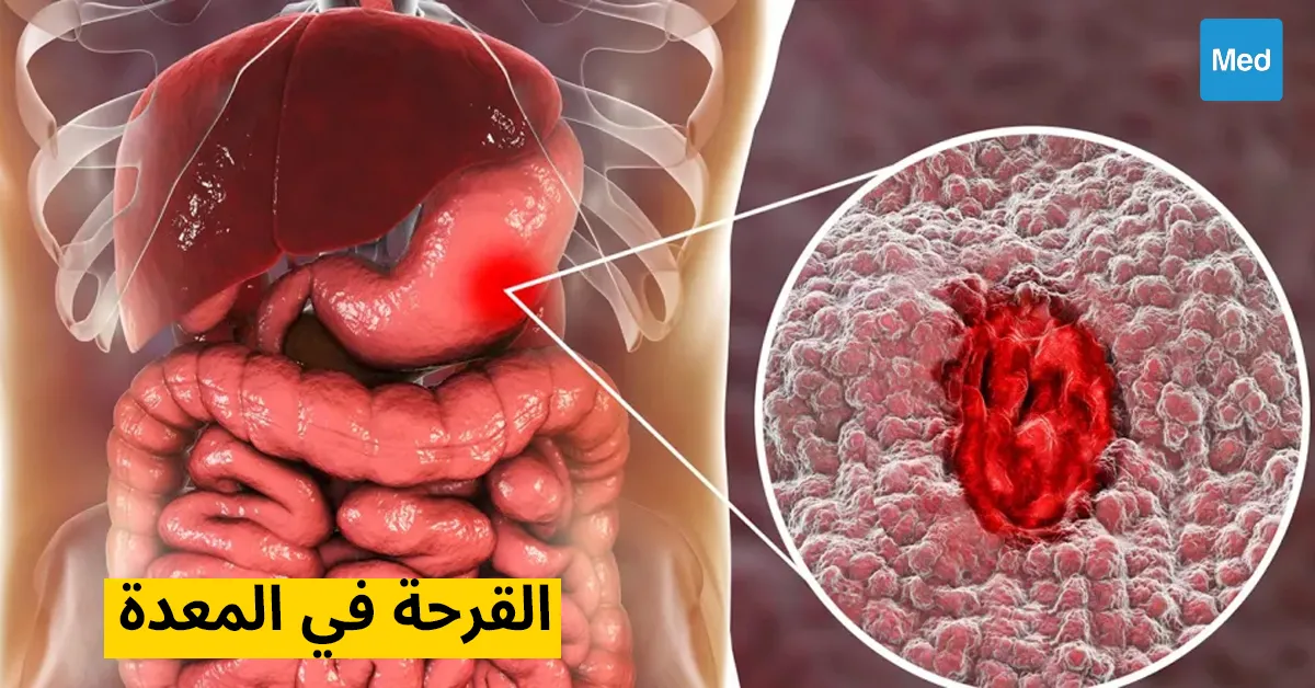 القرحة في المعدة 